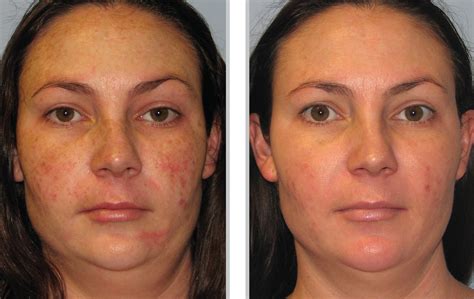 Ipl Before And After Photos Phototherapy Bblipl
