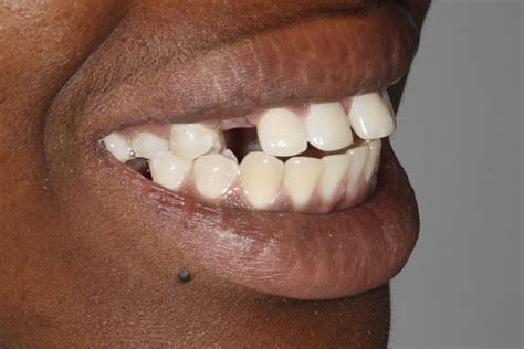 Before And After Dental Implants Dentist In Kent