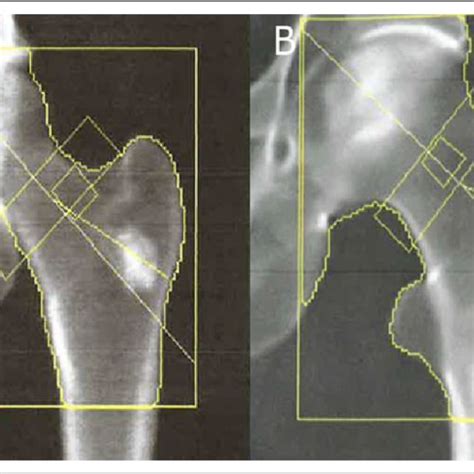 Benign Bone Lesions Are Frequently Encountered On Dual Energy X Ray
