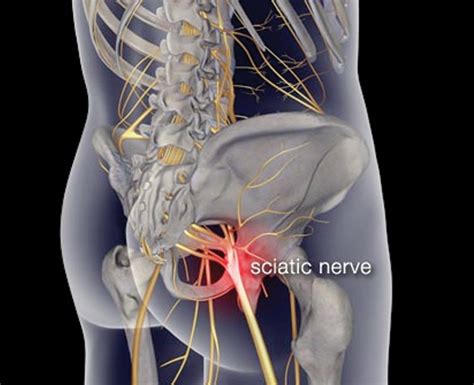 6 Natural Remedies That Will Take Your Sciatic Pain Away