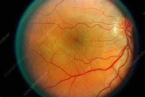 Normal Retina Stock Image C0031346 Science Photo Library