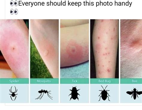 Mosquito Bite Bruise Pictures Peepsburghcom