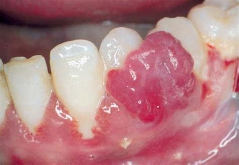 Odontoblog Hemangioma Capilar Lobular