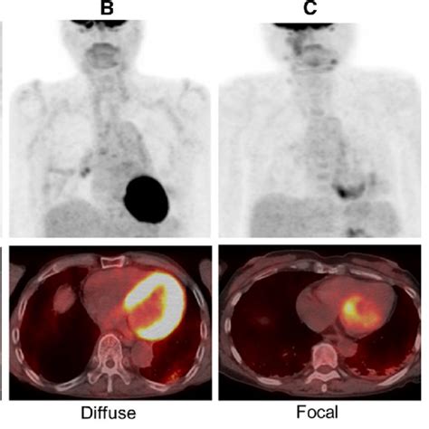 Diagnostic Criteria Of Myocardial 18 F Fdg Petct Imaging Mip Images