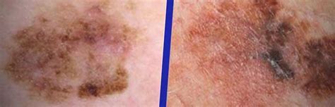Causes And Treatment Of Brown Skin Spots Pictures And