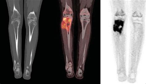 Petct Image Of A 15 Year Old Female Patient Diagnosed With Ewings