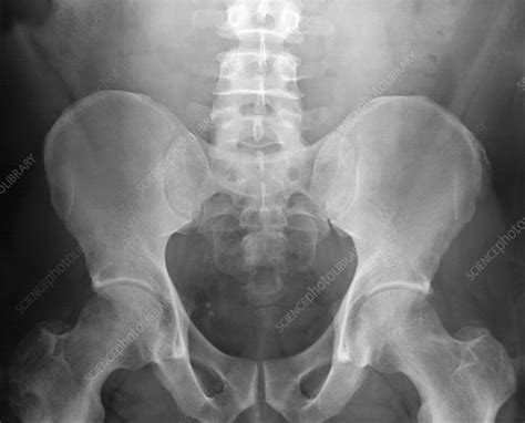 Pelvic Anatomy Xray 5145 Likes 82 Comments The Radiologist
