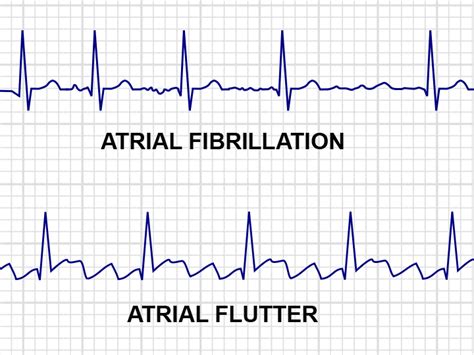 Atrial Fibrillation Atrial Flutter Images