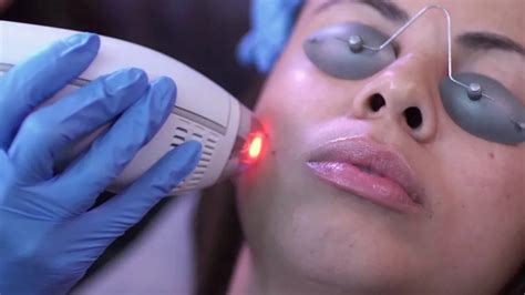 Clear And Brilliant Laser Treatment Review