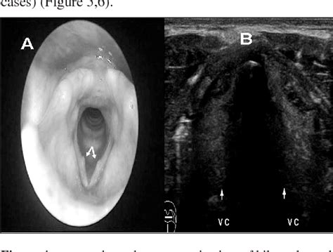 Figure 4 From Laryngeal Ultrasound For Diagnosis Of Vocal Cords Lesions