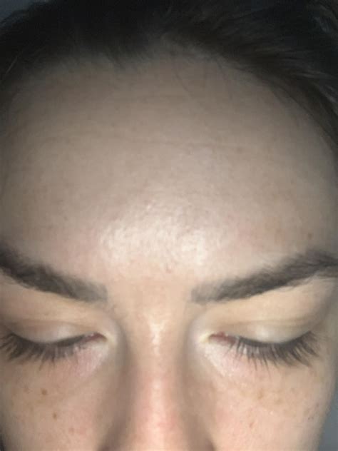 Skin Concerns 23 Yo With Forehead Lines Dehydration Or Aging And