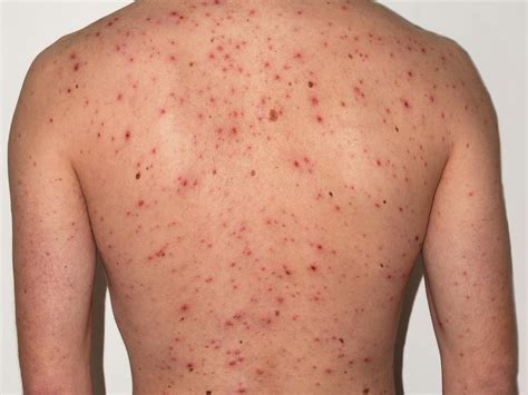 The appearance of viral rashes depends on the kind of measles is a common viral rash caused by a respiratory virus. What to know about viral rash in adults and babies ...