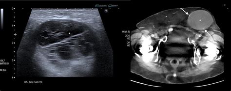 Haematoma Transverse Ultrasound Image Left Of The Right Groin Of A