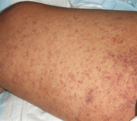 Petechial Rash On A Patient With Rocky Mountain Spotted Fever Caused By
