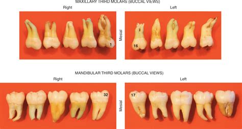 maxillary and mandibular third molar type traits pocket dentistry