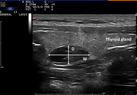 Role Of Ultrasound In The Differentiation Of Parathyroid Carcinoma And