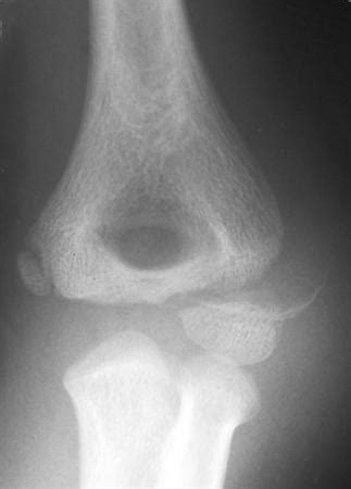 Lateral Condyle Fracture - Pediatric - Pediatrics ...