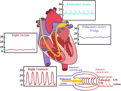 Swan Ganz Standard Thermodilution Pulmonary Artery Catheter Permits