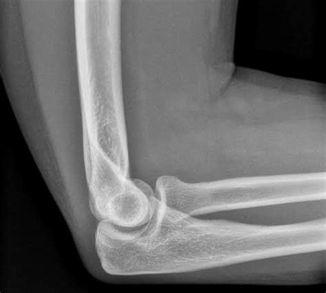 Normal Lateral Elbow Radiograph Radiology Case Radiographer Radiology