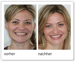 Check spelling or type a new query. Non-Prep-Veneers | Zahnarztpraxis Angela Heymel in Essen ...