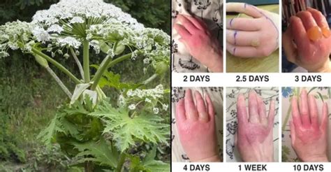 Officials Warn Of Dangerous Plant Causes Blindness And 3rd Degree Burns