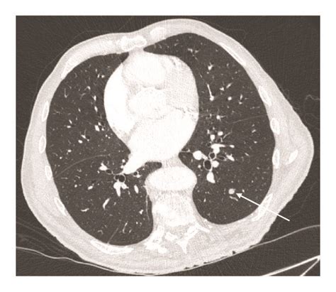 Axial CT Image Of The Chest With Lung Windows Revealing A Pulmonary