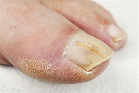 3 Very Simple Ways To Treat A Toenail Fungal Infection Effectively