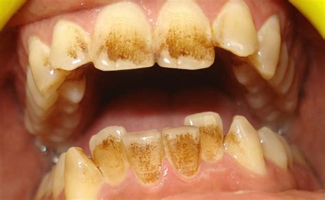 got tea and coffee stains on your front teeth get scaling and polishing done at chauhan s