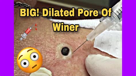 Dilated Pore Of Winer Extractionremoval 2019 Video Youtube