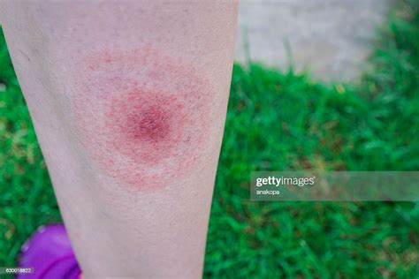 Lyme Disease Borreliosis Or Borrelia Typical Lyme Rash Spot High Res