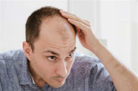 Causes Of Male Pattern Baldness Naples Fl Treatment Options