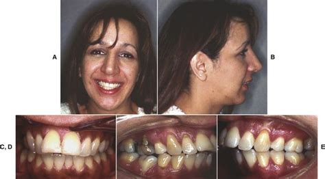 17 Adult Interdisciplinary Orthodontic Treatment Pocket Dentistry