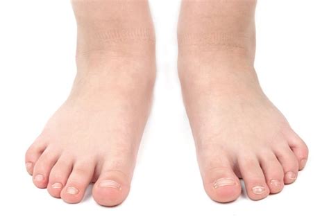 Problem Childrens Feet Treatment Alberta The Foot Institute