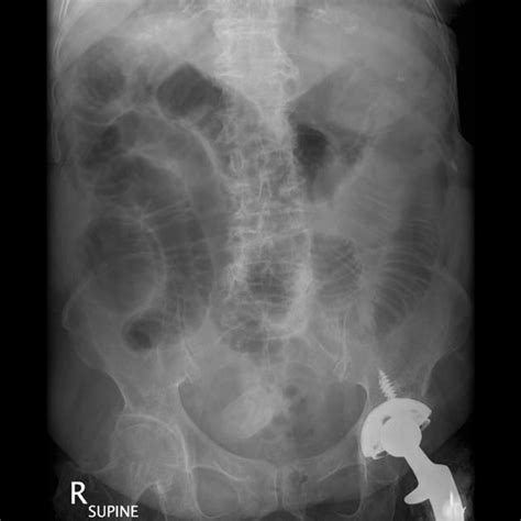 Gallstone Ileus Radiology Case Radiology