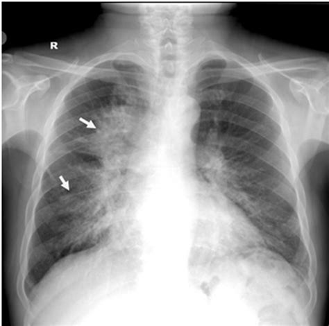 Chest X Ray Of Patient Showing Prominent Hilums And A Cavitary Lesion