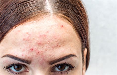 Hormonal Acne Causes How To Treat It And Foods To Avoid