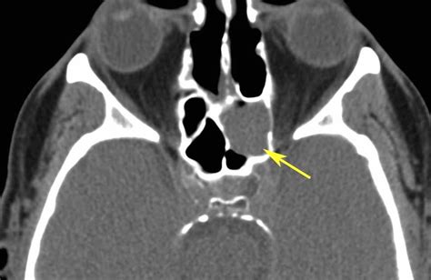 Rit Radiology Sphenoid Sinus Mucocele