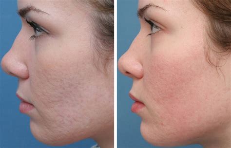Acne Treatment Downtown La Clear Skin And Laser Acne Scar Removal
