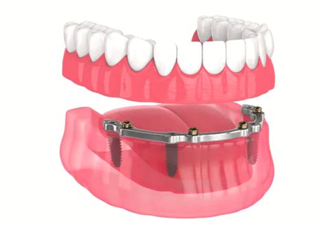 What Are Implant Retained Dentures Tumut Dental Clinic