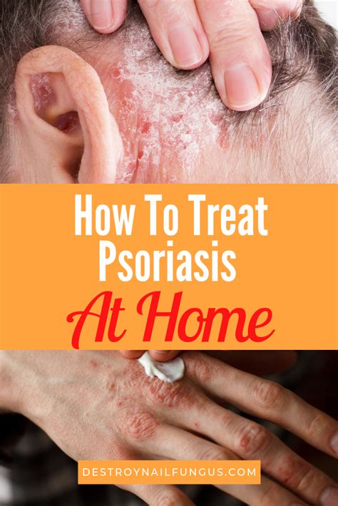 Nail Psoriasis Home Remedy Nail Ftempo