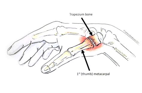 Diagram Of Thumb Joints