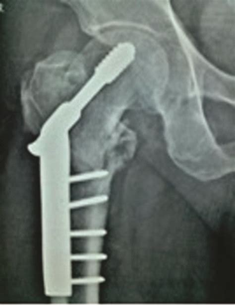 Hip Instability Following Dhs Fixation Surgery For Unstable Four Part