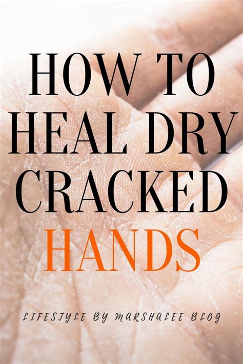 How To Heal Dry Cracked Hands In 2021 Dry Cracked Hands Healing Dry