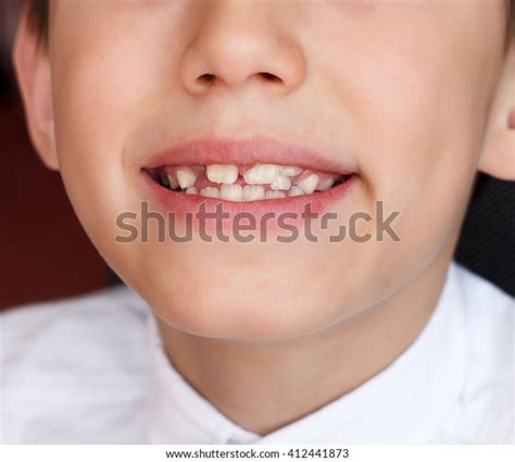 Little Boy Crooked Teeth Stock Photo 412441873 Shutterstock