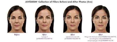 What Can Juvederm Do For You Utah Facial Plastics