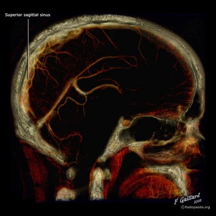 Superior Sagittal Sinus Radiology Reference Article Radiopaedia Org