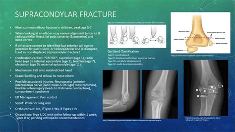 Supracondylar Elbow Fracture • Most Common Elbow Fracture Grepmed