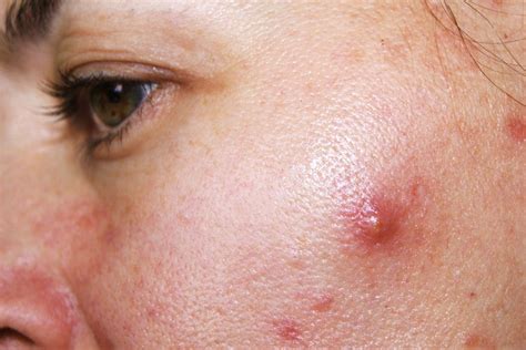 Cystic Acne 101 What Are They What Are The Causes And How Do We