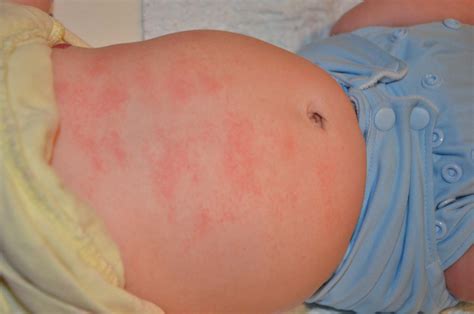 What Causes Red Rashes On Babies Face Printable Templates Protal