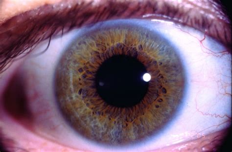 In 2020, an estimated 276,480 new cases of invasive breast cancer are. Iridology, Nutrition and Cognition Research: Diagnosis: R ...